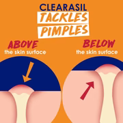 Clearasil graphic showing treatment of pimples above and below the skin surface