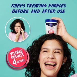 Keeps treating pimples before and after use